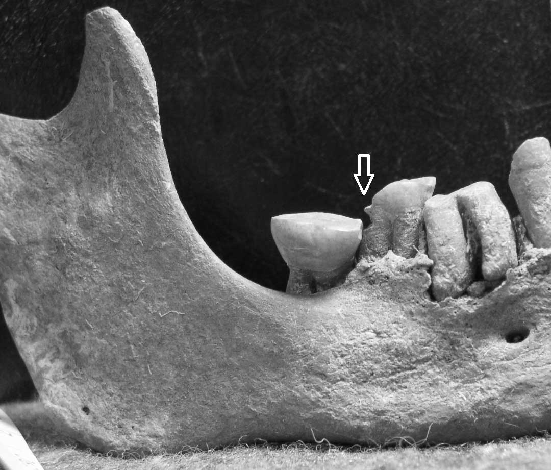 WLH 4 mandible, arrow shows the location of interproximal groove on the second molar.